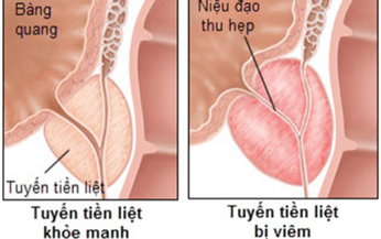 Vi&#234;m tuyến tiền liệt l&#224; g&#236;, nguy&#234;n nh&#226;n, triệu chứng v&#224; c&#225;ch chữa trị