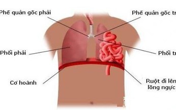 Thuốc điều trị bệnh tho&#225;t vị ho&#224;nh ở trẻ em