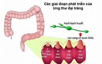 Ung thư đại tr&#224;ng: Nguy&#234;n nh&#226;n, biểu hiện, c&#225;ch điều trị v&#224; ph&#242;ng bệnh