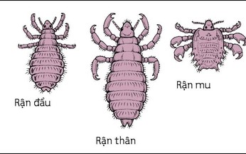 C&#225;c biện ph&#225;p điều trị chấy rận