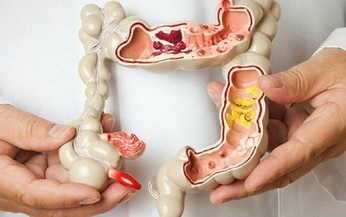 C&#225;c phương ph&#225;p điều trị bệnh Crohn