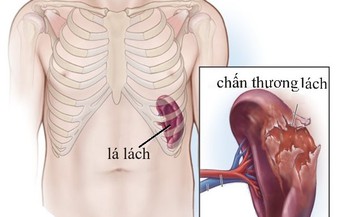 Thuốc v&#224; c&#225;c phương ph&#225;p điều trị chấn thương l&#225;ch