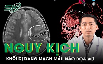 Bệnh nhi nguy kịch v&#236; khối dị dạng mạch m&#225;u n&#227;o dọa vỡ 