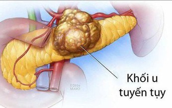 Ung thư tụy: Nguy&#234;n nh&#226;n, triệu chứng, c&#225;ch điều trị v&#224; ph&#242;ng bệnh