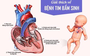 Tim bẩm sinh: Nguy&#234;n nh&#226;n, triệu chứng, phương ph&#225;p điều trị