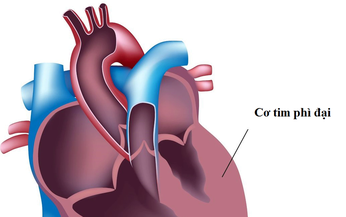 Cơ tim ph&#236; đại: Nguy&#234;n nh&#226;n, biểu hiện, c&#225;ch điều trị v&#224; ph&#242;ng bệnh