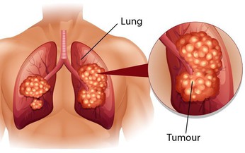 Ung thư phế quản phổi nguy&#234;n ph&#225;t: Nguy&#234;n nh&#226;n, triệu chứng, c&#225;ch điều trị v&#224; ph&#242;ng bệnh