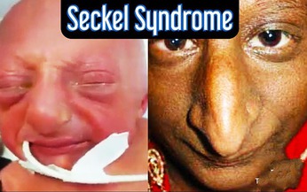 Hội chứng seckel: Nguyên nhân, biểu hiện, cách điều trị và phòng bệnh
