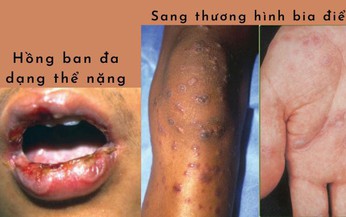 Hồng ban đa dạng: Nguyên nhân, biểu hiện, cách điều trị và phòng bệnh
