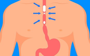 Hẹp thực quản: Nguyên nhân, biểu hiện, cách điều trị và phòng bệnh