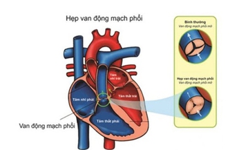 Câu hỏi thường gặp liên quan đến bệnh hẹp động mạch phổi