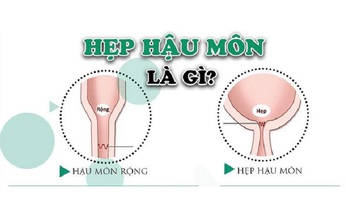 Câu hỏi thường gặp liên quan đến hẹp hậu môn ở trẻ em