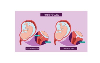 Câu hỏi thường gặp liên quan đến bệnh hở eo tử cung