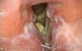 Thuốc điều trị lao thanh quản