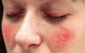 Câu hỏi thường gặp về hội chứng Carcinoid