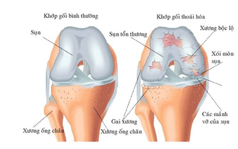 Người bệnh thoái hóa khớp gối tập luyện thế nào cho phù hợp?