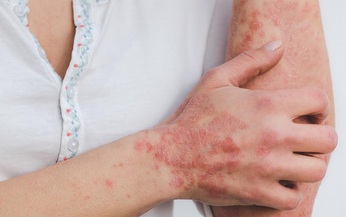 Câu hỏi thường gặp liên quan đến bệnh Lichen Nitidus