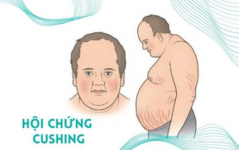 Người mắc hội chứng Cushing tập luyện thế nào có lợi cho sức khỏe?