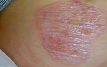Câu hỏi thường gặp liên quan đến bệnh lichen xơ hóa
