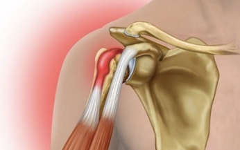 Viêm gân nhị đầu vai: Nguyên nhân, triệu chứng, cách điều trị và phòng ngừa