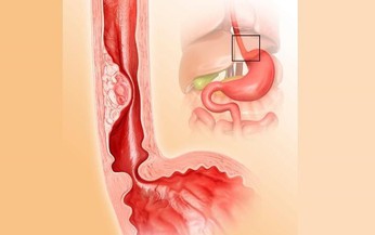 Câu hỏi thường gặp liên quan đến bệnh hẹp thực quản