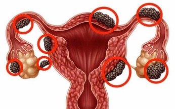 Lạc nội mạc tử cung: Nguyên nhân, triệu chứng, phòng ngừa và điều trị