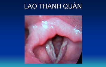 Lao thanh quản: Nguyên nhân, biểu hiện, cách điều trị và phòng bệnh
