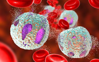 Leukemia kinh dòng bạch cầu hạt: Nguyên nhân, biểu hiện, cách điều trị và phòng bệnh