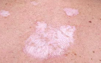 Lichen xơ hóa: Nguyên nhân, biểu hiện, cách điều trị và phòng bệnh