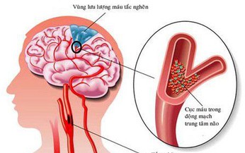 Câu hỏi thường gặp về bệnh xơ vữa động mạch não