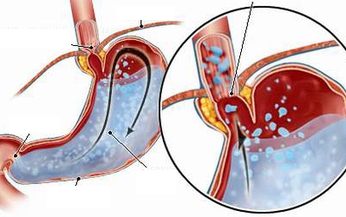 Trị chứng rối loạn ti&#234;u h&#243;a thường gặp ở trẻ