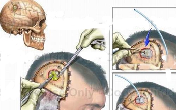 C&#225;ch ph&#225;t hiện &#225;p-xe n&#227;o