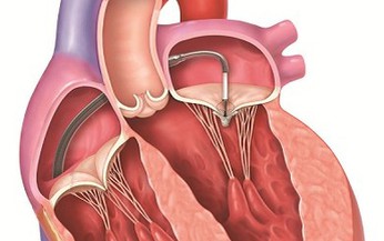 Điều trị hở van tim hai l&#225; kh&#244;ng cần phẫu thuật