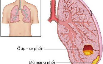 &#208;ể kh&#244;ng bị &#225;p-xe phổi