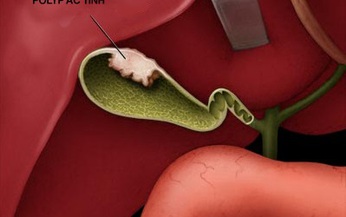 Mối nguy tiềm ẩn từ polyp túi mật