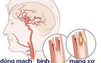 Hẹp động mạch cảnh c&#243; li&#234;n quan tới tr&#237; n&#227;o