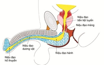 Hẹp niệu đạo