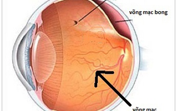 Ai dễ bị bong v&#245;ng mạc?