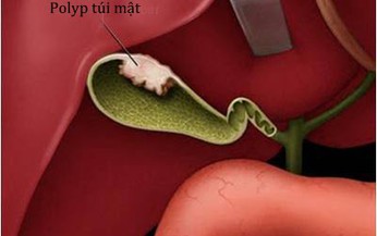 Polyp túi mật có nên mổ?