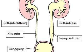 Thận ứ nước cần ki&#234;ng g&#236;?