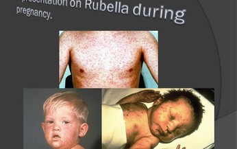 Rubella - Căn bệnh kh&#244;ng thể xem nhẹ