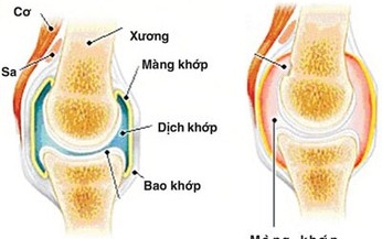 Bệnh vi&#234;m khớp phản ứng v&#224; vi&#234;m mắt