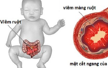 Vi&#234;m đường ruột