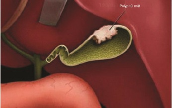 Tại sao bạn bị polyp túi mật?