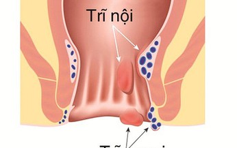 Tại sao mắc trĩ ngoại?