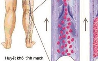 Đột tử do huyết khối tĩnh mạch s&#226;u