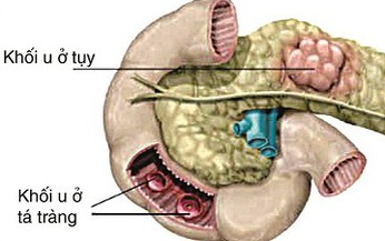 Thuốc điều trị hội chứng Zollinger - Ellison