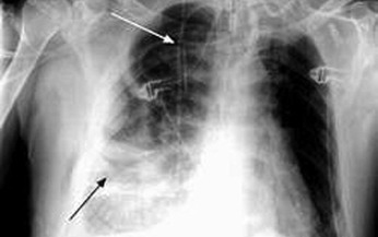 Nhận biết sớm viêm mủ màng phổi - Cách gì?