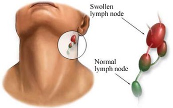 Bệnh u lympho &#225;c t&#237;nh kh&#244;ng Hodgkin c&#243; dễ ph&#225;t hiện?