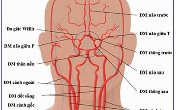 Hẹp động mạch cảnh, nguy hiểm thế n&#224;o?